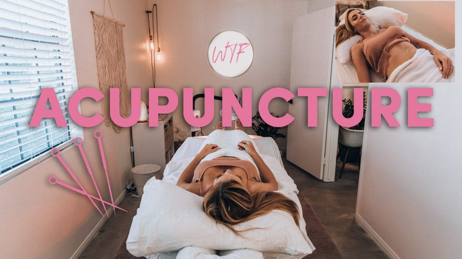 I Tried Acupuncture!